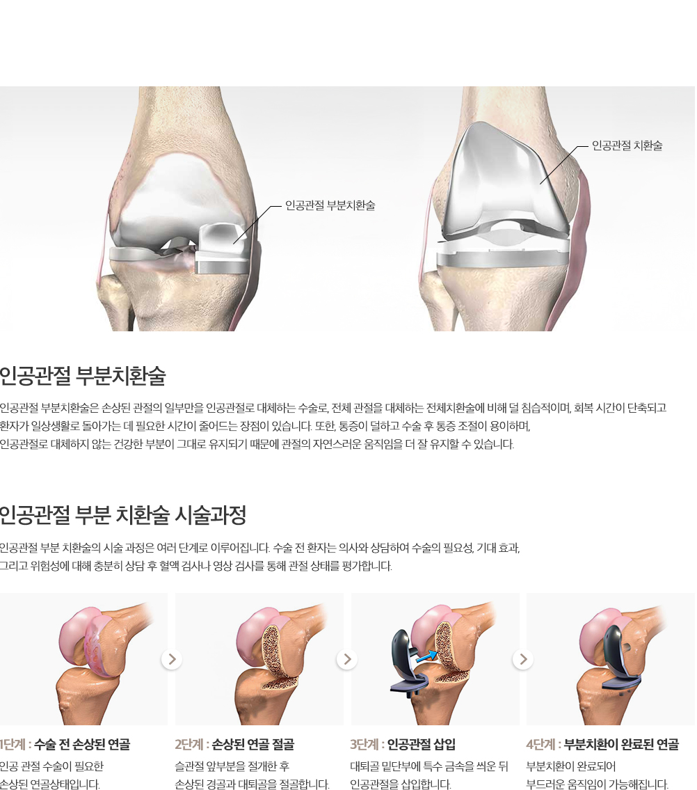 인공관절 부분치환술 설명