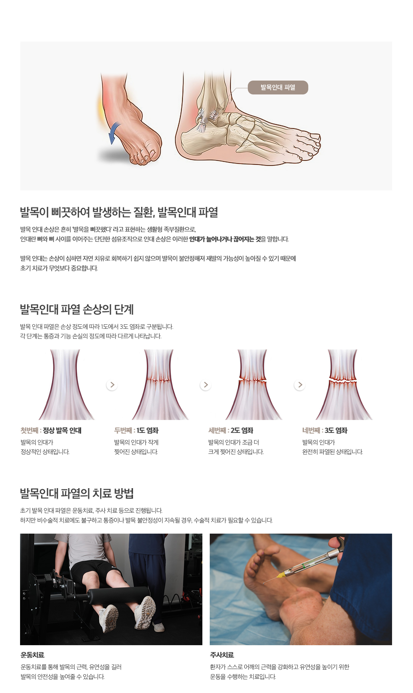 발목관절 인대파열