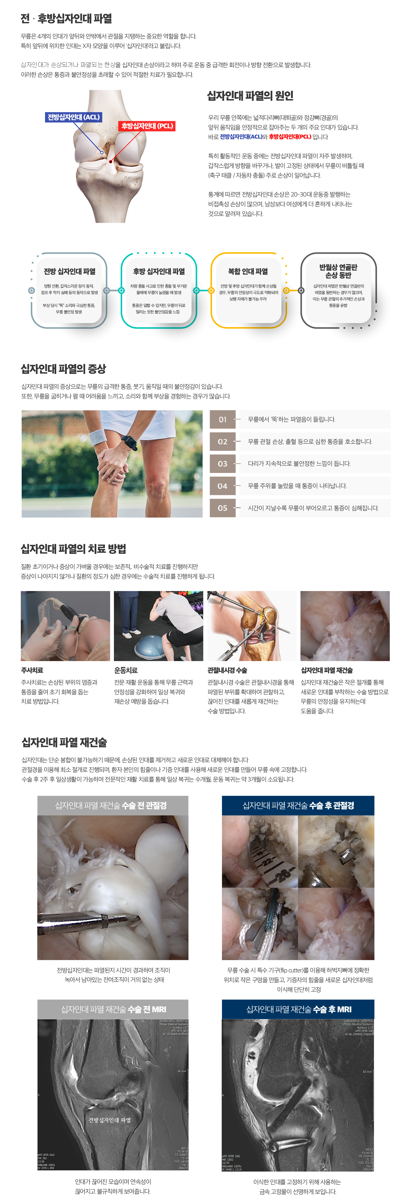 전,후방십자인대 파열